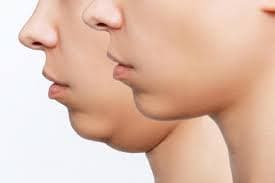 Double Chin Correction