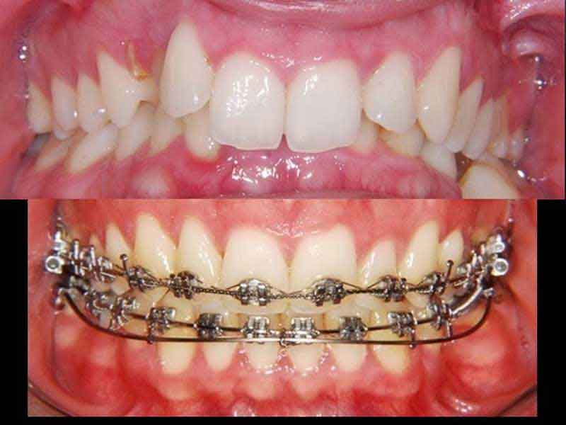 Orthodontic Treatments