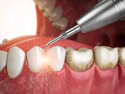 Teeth Whitening And Cleaning